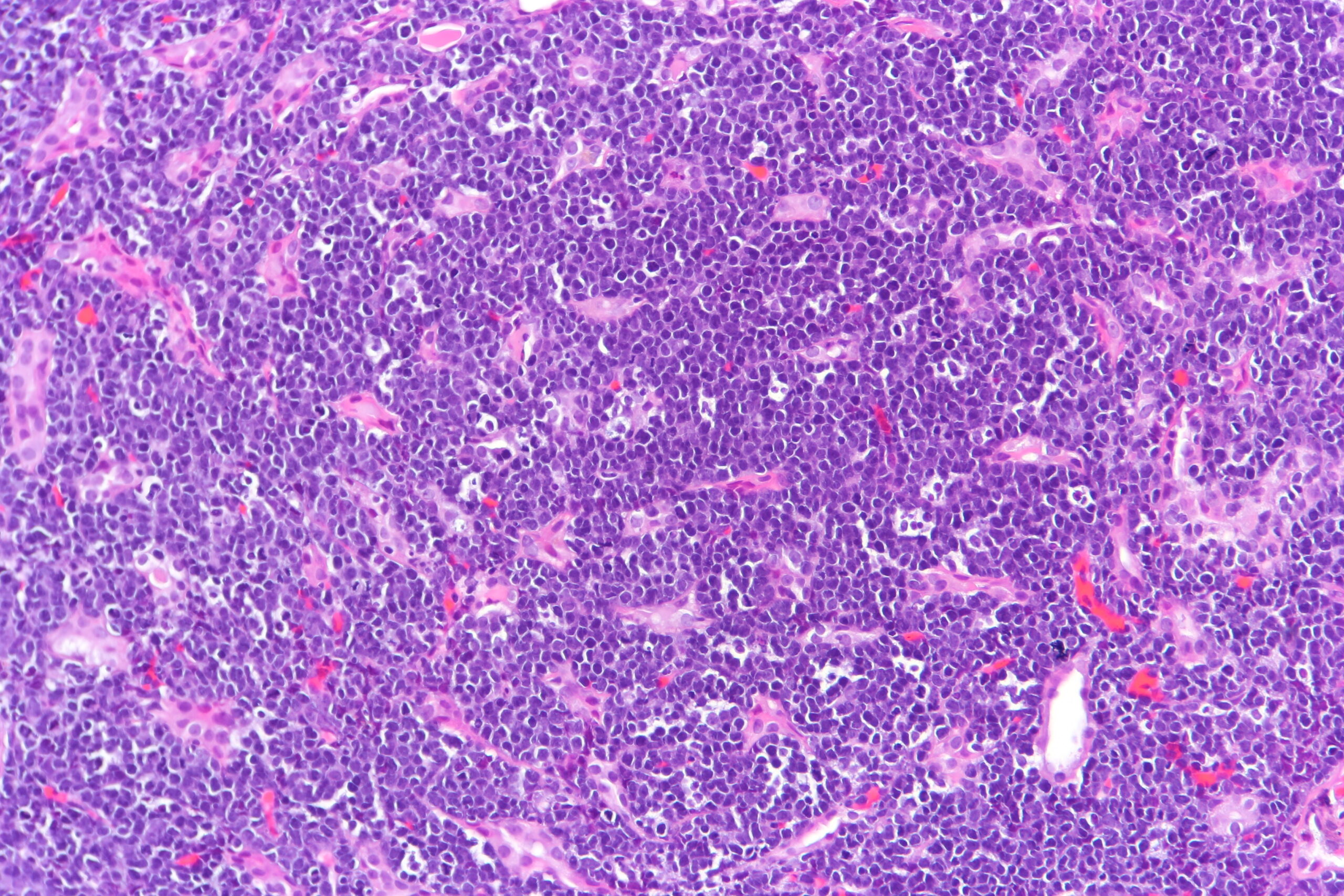 Biopsy 1